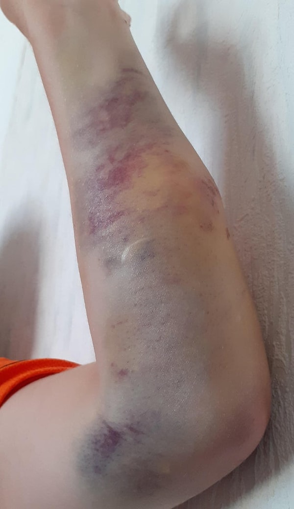 8. «Я упал с лестницы в первый день в школе».