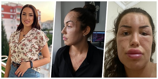 Yüzüne ve Boynuna 200 İğne Yaptılar: 'Gençlik Aşısı' Yaptıran Kadının Yüzü Tanınmaz Hale Geldi