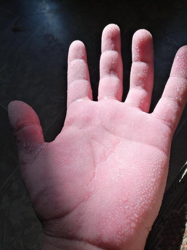 5. "Hiperhidrozum yani aşırı terleme hastalığım var ve ellerim çok terliyor. Genellerde ellerim böyle gözüküyor."