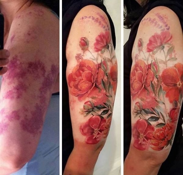 3. "Фото до и после татуирования родимого пятна цвета потрвейна"