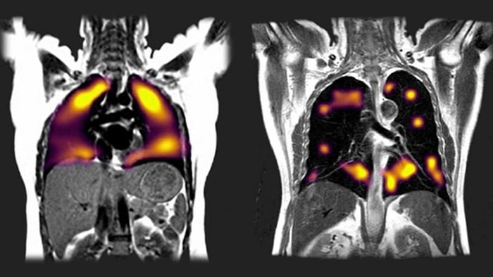 Yeni Tarama Tekniği, Koronavirüsün Akciğerlerde Neden olduğu Hasarı 'Gösterdi'