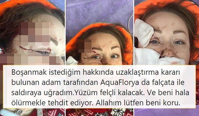 Boşanmak İstediği Eşi Tarafından Yüzü Parçalanan Kadının Yardım Çığlığı: 'Allahım Lütfen Beni Koru'