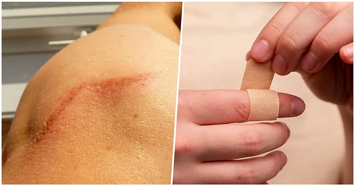 Vücudumuzdaki Eski Yara İzleri Neden Geçmez?