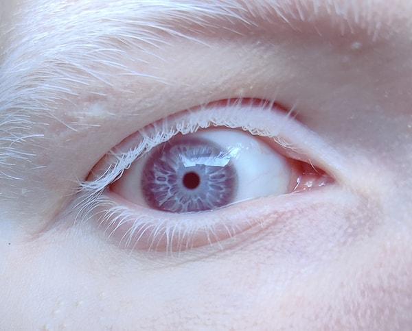 12. "Albino hastalığım var ve yakından gözlerim inanılmaz görünüyor!"