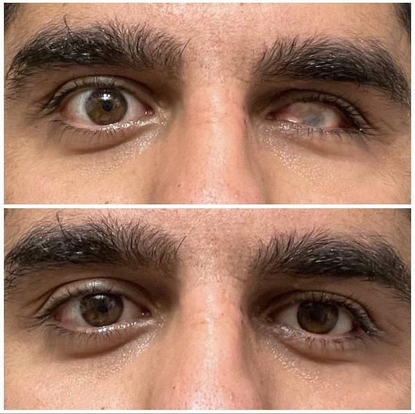 1. Bir adamın sahte gözünü taktıktan önce ve sonraki hali.