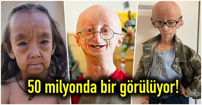 10 Yaşındaki Çocukların 70 Yaşında Gibi Gözükmesine Neden Olan Progeria Sendromu’nu İnceliyoruz