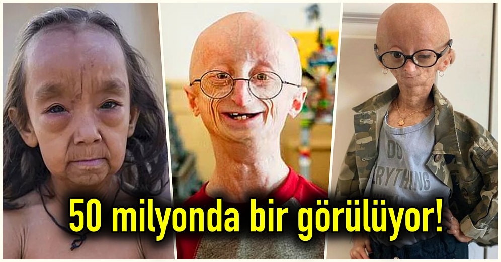 10 Yaşındaki Çocukların 70 Yaşında Gibi Gözükmesine Neden Olan Progeria Sendromu’nu İnceliyoruz