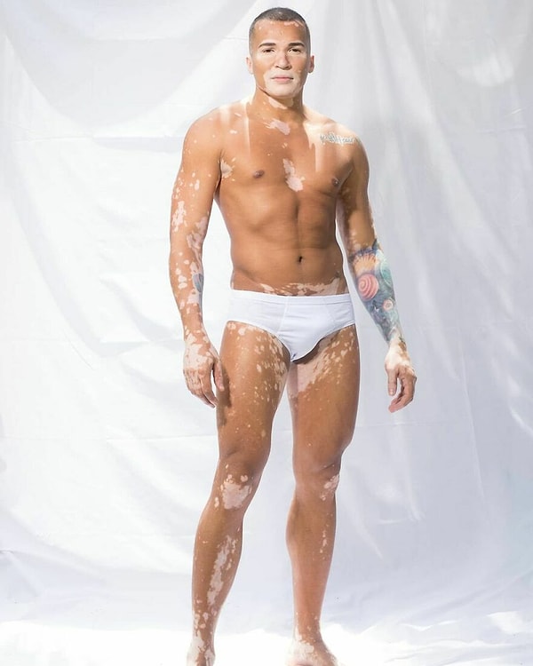 Из-за недостатка меланина на его коже появляются белые пятна.