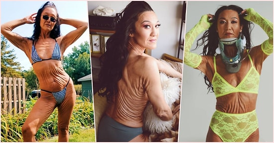 Ehlers-Danlos Sendromu Yüzünden Yaşlı Gözüken 29 Yaşındaki Kadının ‘Helal Olsun!’ Dedirtecek Hikâyesi