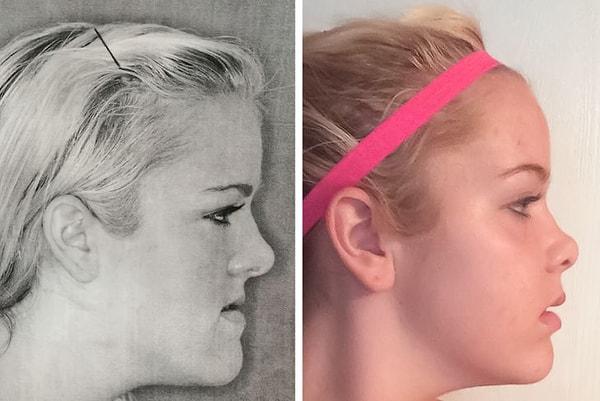 14. "Çene ameliyatımdan önce ve sonra"