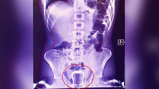 Kaza Olmuş: Hacamat Yaptıran Adamın Anüsüne Çay Bardağı Kaçtı