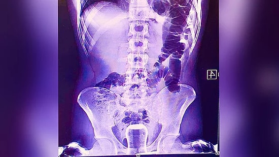 Hacamat Nedir, Neden Yapılır?