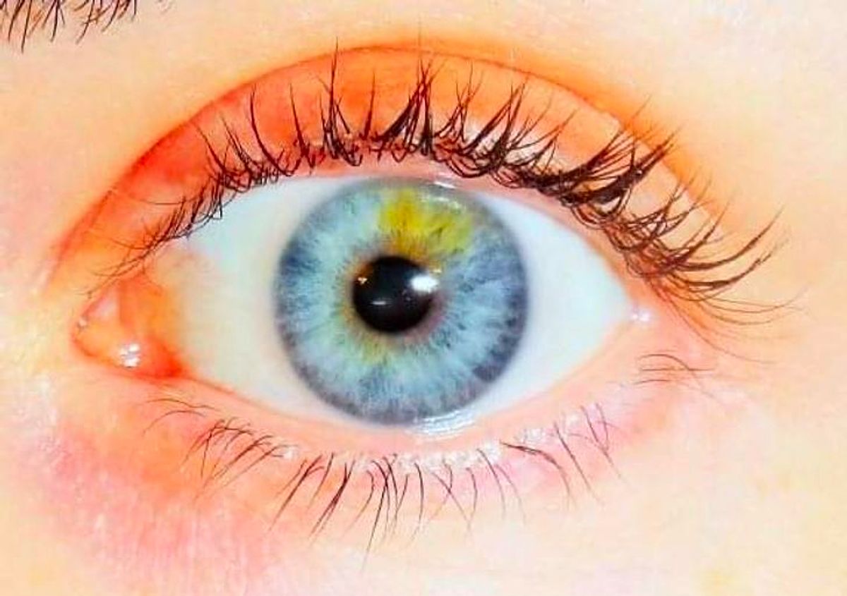 My left eye. Гетерохромия и анизокория. Двойной ряд ресниц. Анизокория.