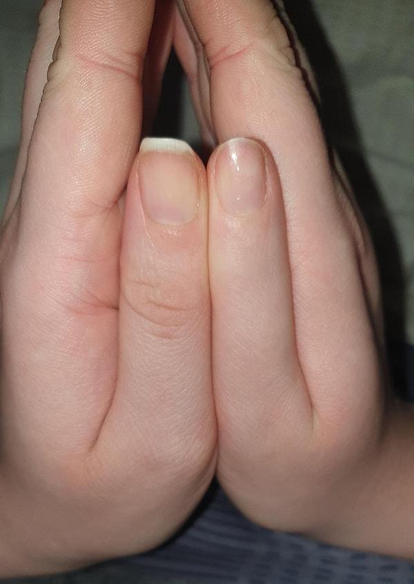 6. " Sağ baş parmağımın eklemi gelişmedi. O yüzden parmağımı bükemiyorum."