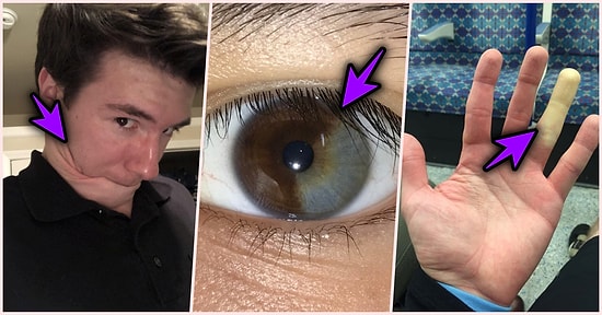 Özel Olduklarını Vücutlarındaki Büyüleyici Anomalilikleri Paylaşarak Herkese Kanıtlayan 17 Cesur Kişi