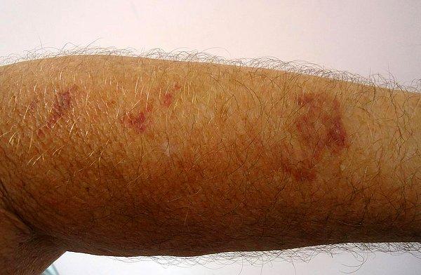 Genellikle 50 yaş üzeri kişilerde görülen senile purpura hastalığı, özellikle kollarda mor ve kırmızı renkte yaralara neden olur.