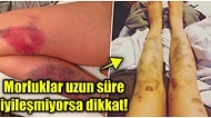Morluklarla Başı Dertte Olanlar Buraya! Vücudunuzda Bir Türlü Geçmek Bilmeyen Yaraların Sebebini Açıklıyoruz