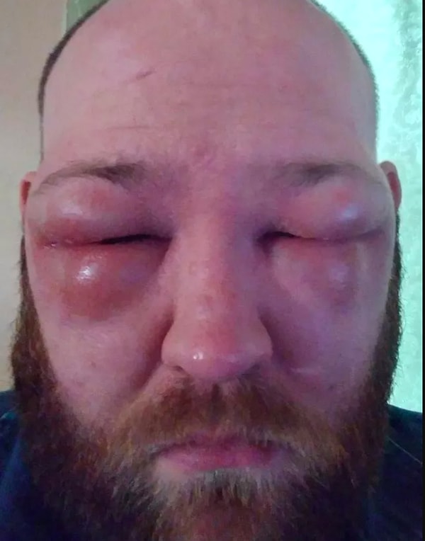 3. "Я задел лицом ядовитый плющ"