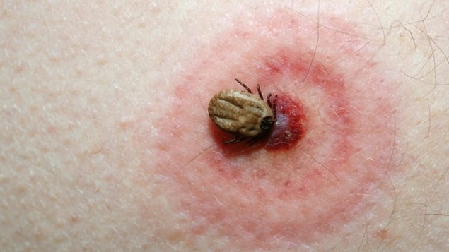 Lyme Hastalığı Nedir?