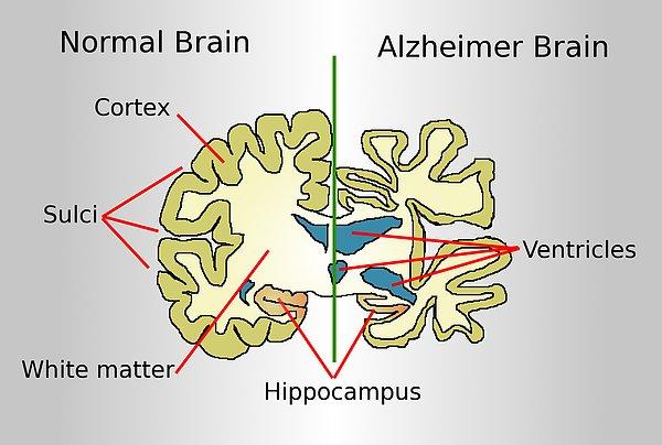 Alzheimer, beyin hücrelerinin küçülerek aktivitesini kaybetmesi ve zamanından önce ölmesinden kaynaklanan bir hastalık.