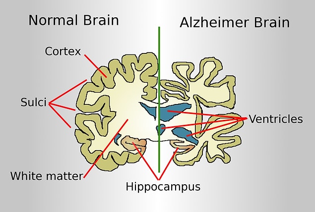Alzheimer, beyin hücrelerinin küçülerek aktivitesini kaybetmesi ve zamanından önce ölmesinden kaynaklanan bir hastalık.