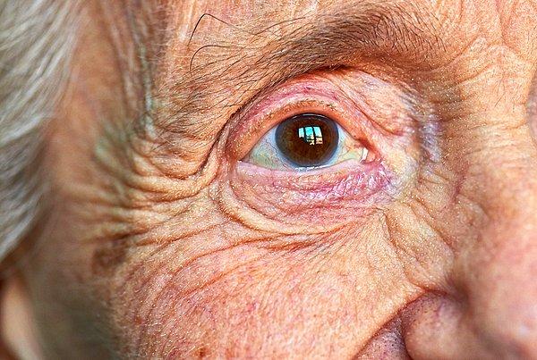 Alzheimer hastalığı, hem dünya hem de Türkiye nüfusunun yaşlanmasıyla birçok kişide görülebiliyor.