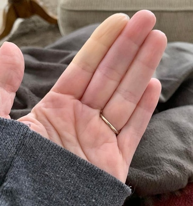 10. Garip bir hastalığı olan bu kadının, üşüdüğünde bazı el veya ayak parmaklarında kan dolaşımını yitirdiğini söylüyor.