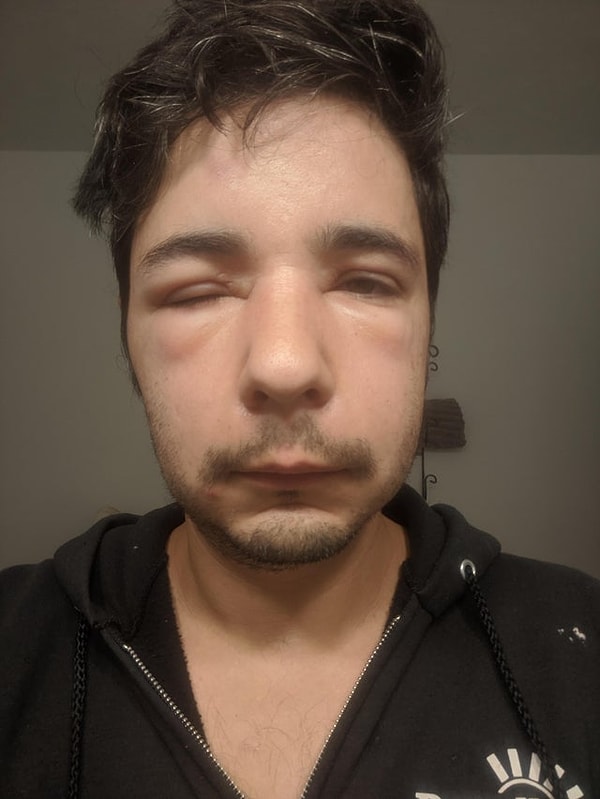 11. "İki kere arı soktu. Önce alnımdan daha sonra da kulağımın üstünden."