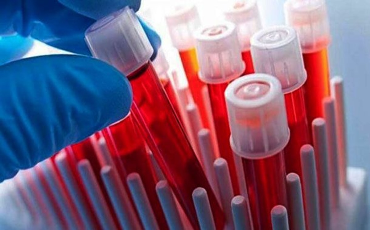 CA 15 3 Nedir? Yüksekliği ve Düşüklüğü Ne Anlamlara Gelir? Değerleri Kaç Olmalıdır?