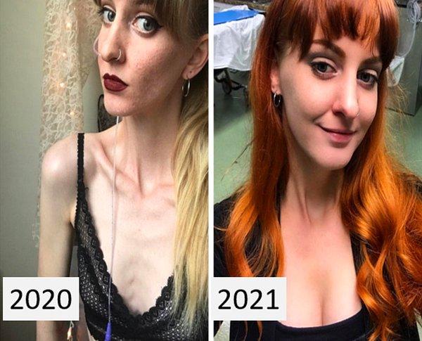 13. "Anoreksiya hastalığımdan öncesi ve sonrası."