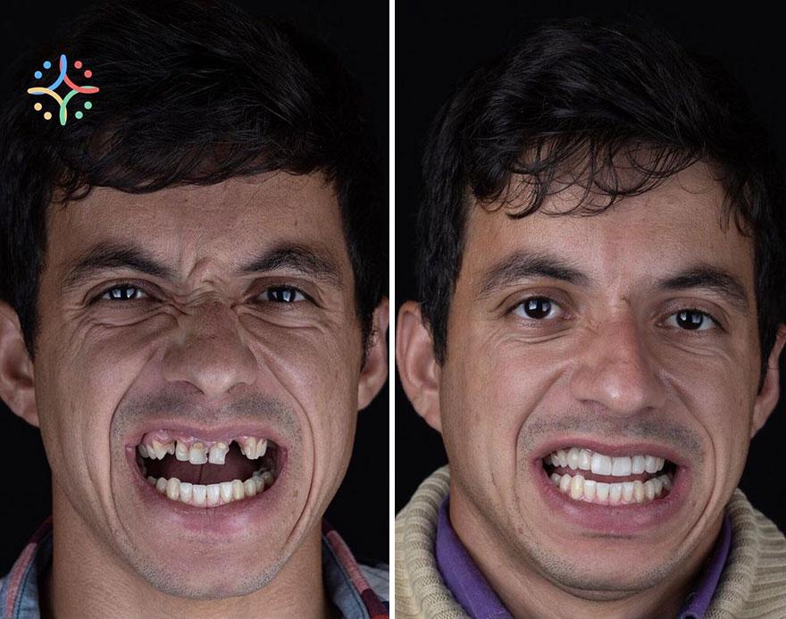 20 преображений от бразильского дантиста, который лечит зубы бедняков бесплатно
