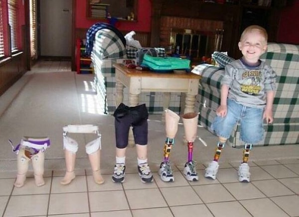 11. В то время как взрослый может использовать один протез в течение десятилетия, ребенку, вероятно, потребуется несколько протезов за этот же период времени.