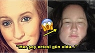 Saçlarını Boyattıktan Sonra Korkunç Bir Alerjik Reaksiyon Göstererek Hastanelik Olan Kadın