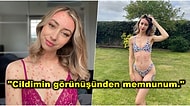 Yaşadığı Sedef Hastalığını Saklamaktansa Tüm Dünyayla Paylaşarak İnsanlara İlham Veren Genç Kadın