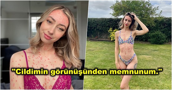 Yaşadığı Sedef Hastalığını Saklamaktansa Tüm Dünyayla Paylaşarak İnsanlara İlham Veren Genç Kadın