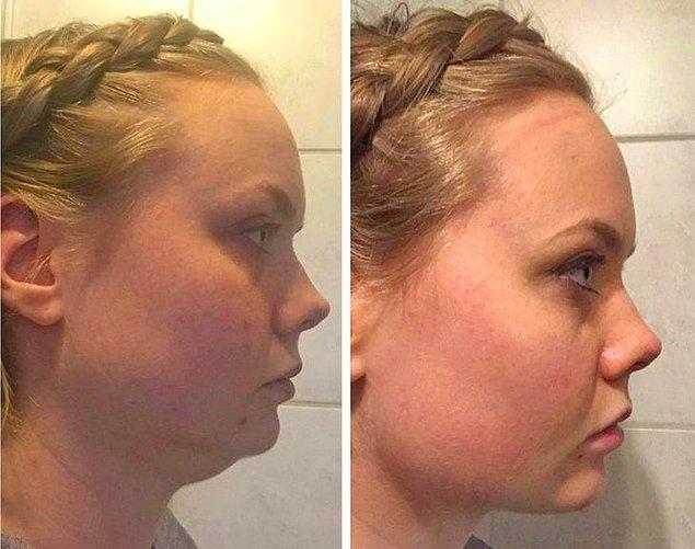 8. "Chemotherapy had ruined my face. It finally got better, 1 month after chin liposuction."