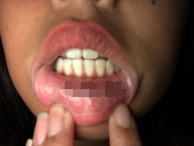 Erkek arkadaşına sürpriz yapmak için adını dudağının içine dövme yaptıran Kazumi, aldatıldığını öğrendikten sonra yıkıldı.