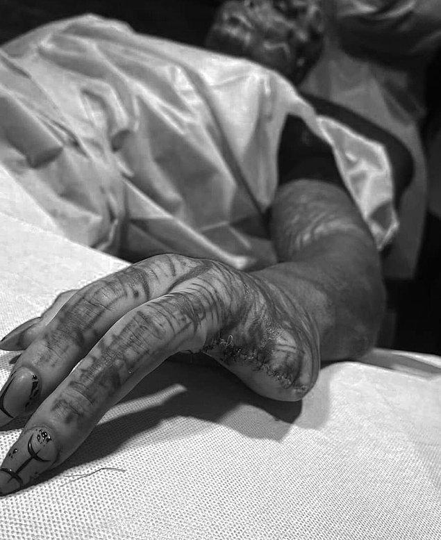 Pençe görünümlü ellere sahip olmak adına sol elindeki iki parmağını ameliyat ile aldırdı!