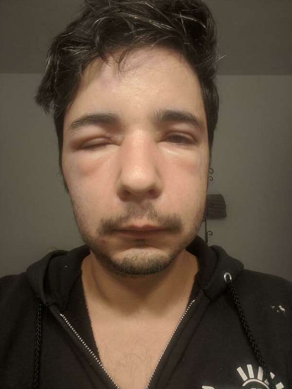 23. Меня ужалили дважды, один раз в лоб и один раз в верхнюю часть уха