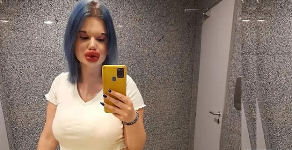 Изменение лица 24-летней Андреа не ограничивается только губами. Недавно она пошла к своему врачу на процедуру удлинения и коррекции контуров лица, чтобы изменить форму подбородка.