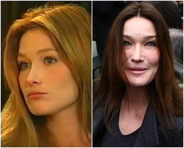 3. Güzeller güzeli model Carla Bruni'nin yaptırdığı botoks işlemleri sonucu değişen yüzü.