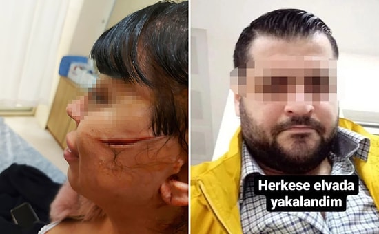 Eski Sevgilisinin Yüzünü Usturayla Kesti, Sosyal Medyadan 'Herkese Elveda Yakalandım' Yazdı