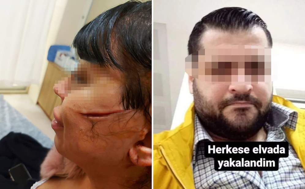 Eski Sevgilisinin Yüzünü Usturayla Kesti, Sosyal Medyadan 'Herkese Elveda Yakalandım' Yazdı