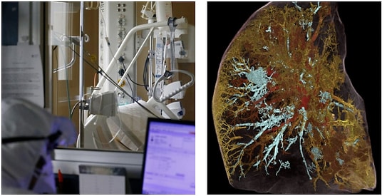 Dünyanın En Net Röntgeni! Kovid-19’dan Ölen Bir Kişinin Akciğerlerini Görüntülediler