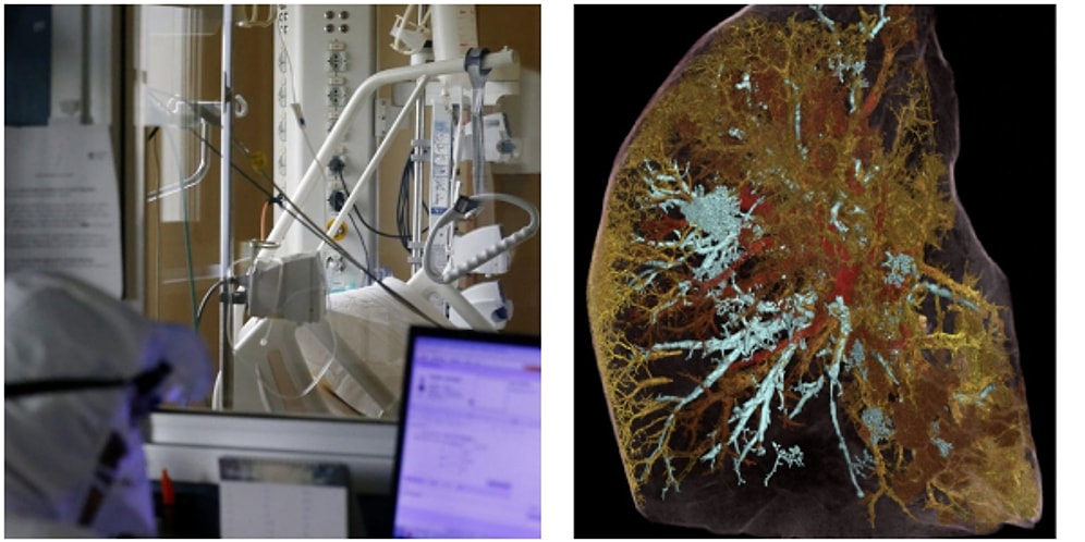 Dünyanın En Net Röntgeni! Kovid-19’dan Ölen Bir Kişinin Akciğerlerini Görüntülediler