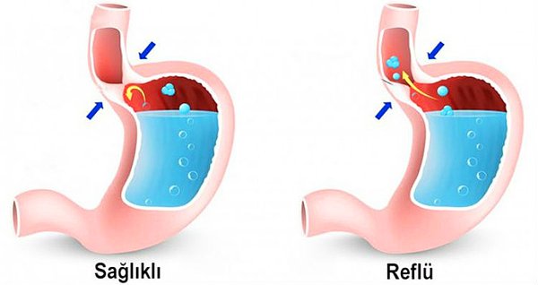 3. Mide yanması ve reflüye sebep olur.