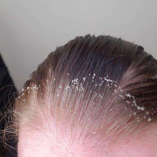 2. Kepek, seboreik dermatit olarak da bilinir. Kepek kuru saçlarda oluşan bir problem sanılır ama bu yanlış.