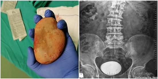Ordu'da Korkunç Olay: Mesanesinden Patates Büyüklüğünde Taş Çıkarıldı