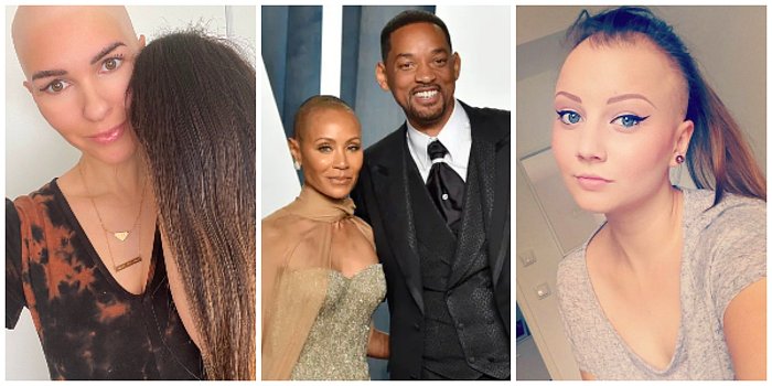 Will Smith'in Eşi Jada Pinkett Smith'in de Musdarip Olduğu Alopesi (Saçkıran) Hastalığı ve Tedavisi