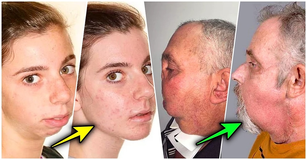 Estetik Ameliyatlar Sayesinde Yaşadıkları Mucize Gibi Değişimlere İnanmakta Zorlanacağınız 16 Kişi